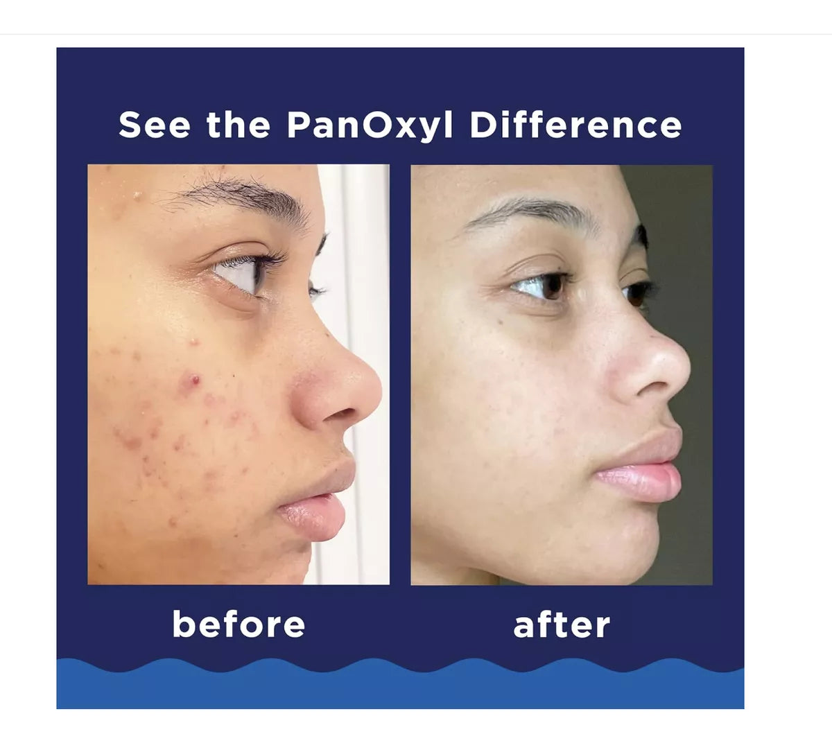 Panoxyl Acné Foaming Wash 10% Peróxido De Benzoilo 156 G